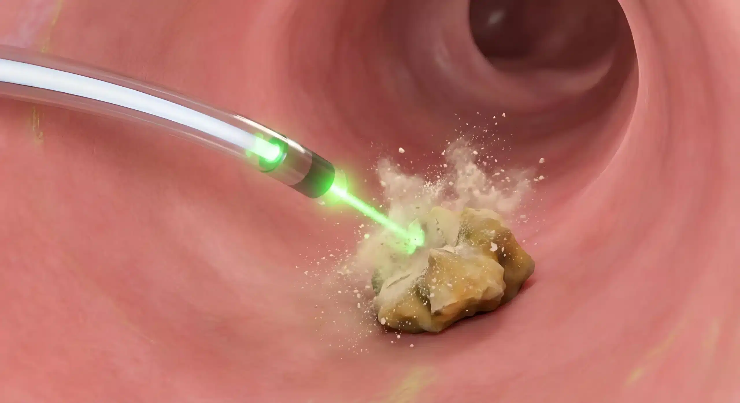 litotricia laser hoyag calculos renales costa rica scaled